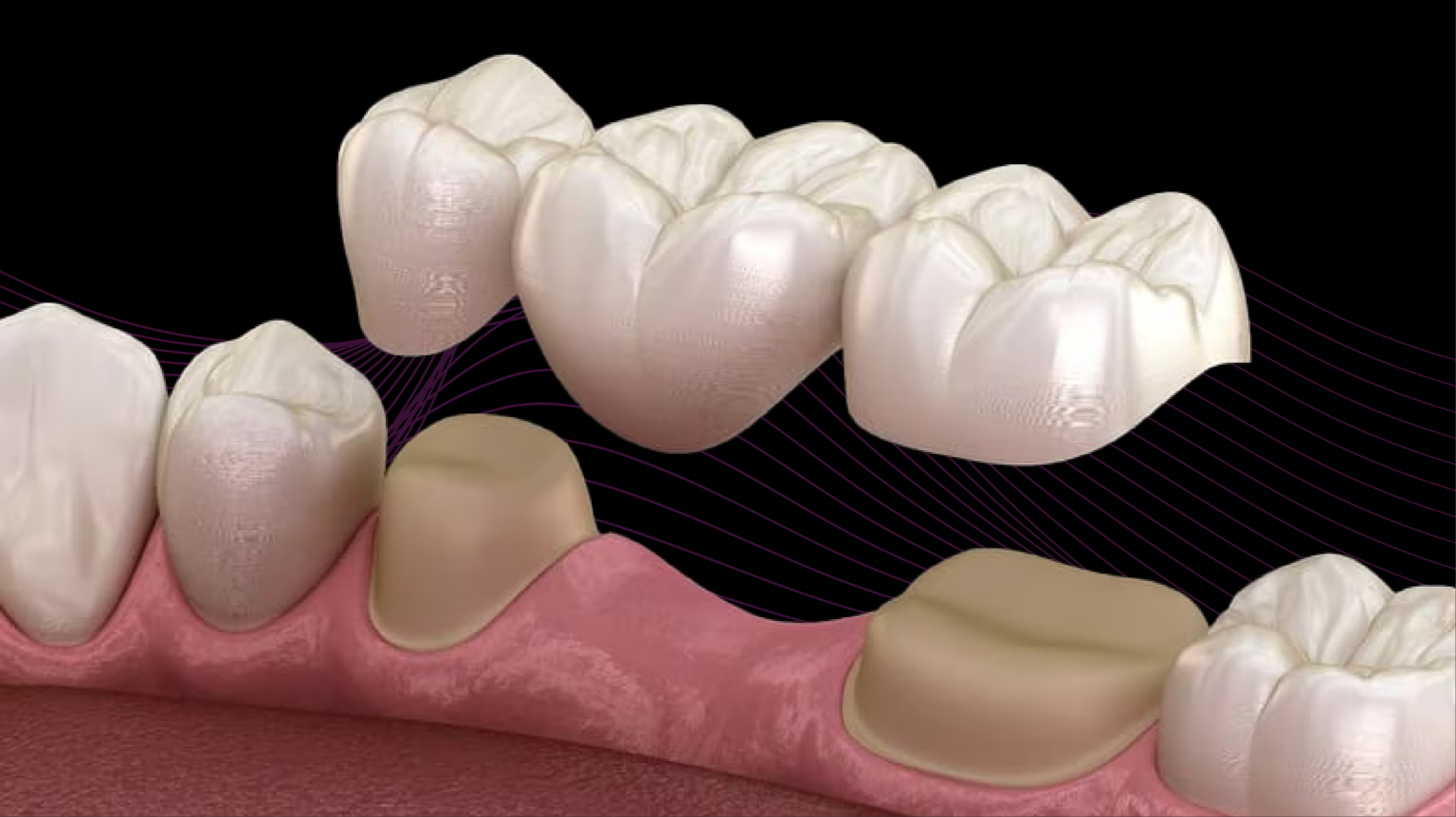 CAD CAM, răng sứ, răng kỹ thuật số, phục hình kỹ thuật số, implant kỹ thuật số