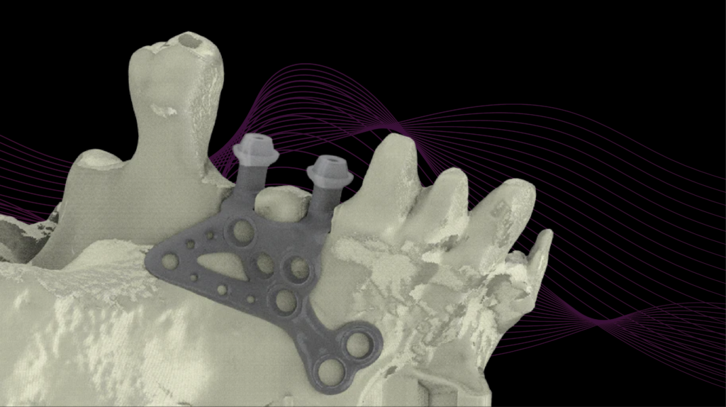 Implant Iuxta, implant màng xương, b&b iuxta